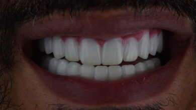 زراعة أسنان لمغربي من مراكش في مركز أسنانك الدولي في اسطنبول مع تركيب أسنان زيركون مع وجه أيماكس