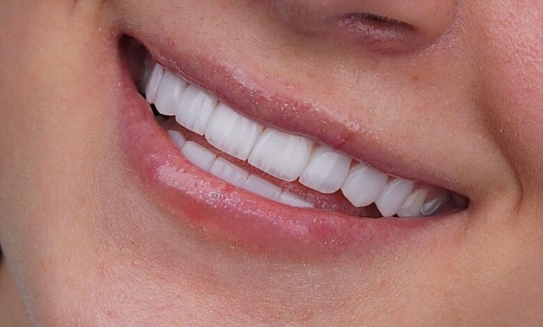 أخر حالات تركيبات الأسنان وأبتسامة هوليود في مركزنا
