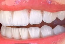مركز الدكتور أنس عبدرالرحمن لزراعة الأسنان ورسم أبتسامة هوليود