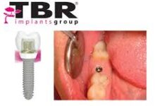 أفضل زرعة أسنان في العالم من شركة TBR السويسرية الفرنسية