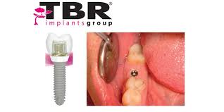 أفضل زرعة أسنان في العالم من شركة TBR السويسرية الفرنسية