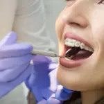 أخر حالات تقويم الأسنان عن طريق تركيبات الزيركون والأيماكس