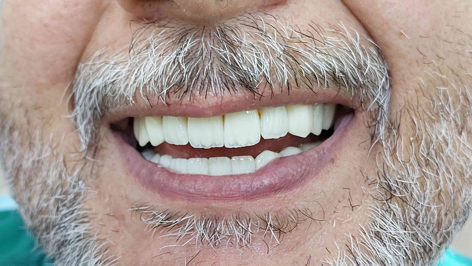 زراعة أسنان لقاضي عراقي تعرض لتجبير الفكين بسبب كسور ناتجه عن حادث