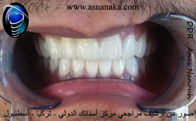 علاج تآكل وتلون أسنان لمراجع من السعودية
