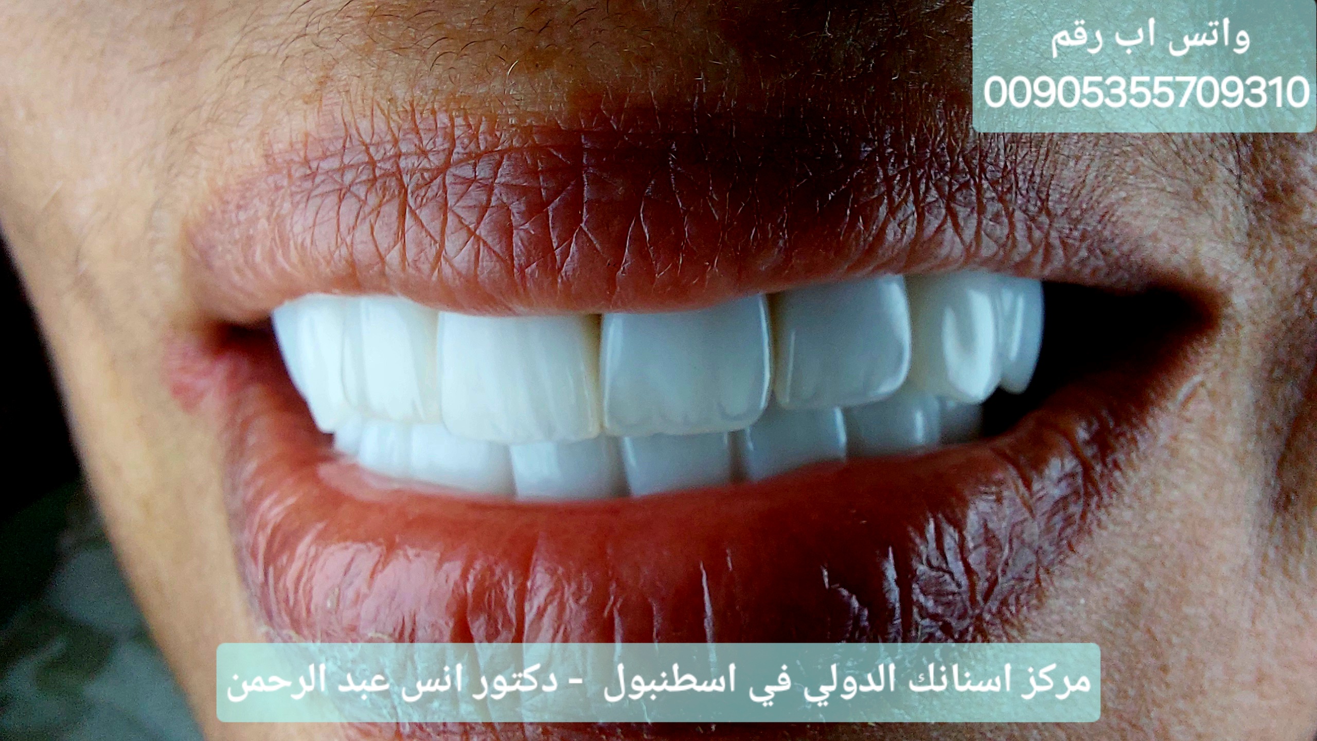 تركيب إبتسامة هوليود رائعة لمغربية بعد زراعة زرعات TBR السويسرية