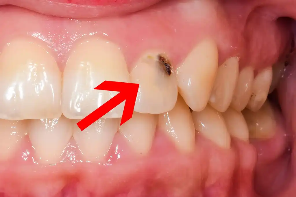 كيف نقلل تاثير المواد الحاوية على السكر على الأسنان و التسبب بالتسوس
