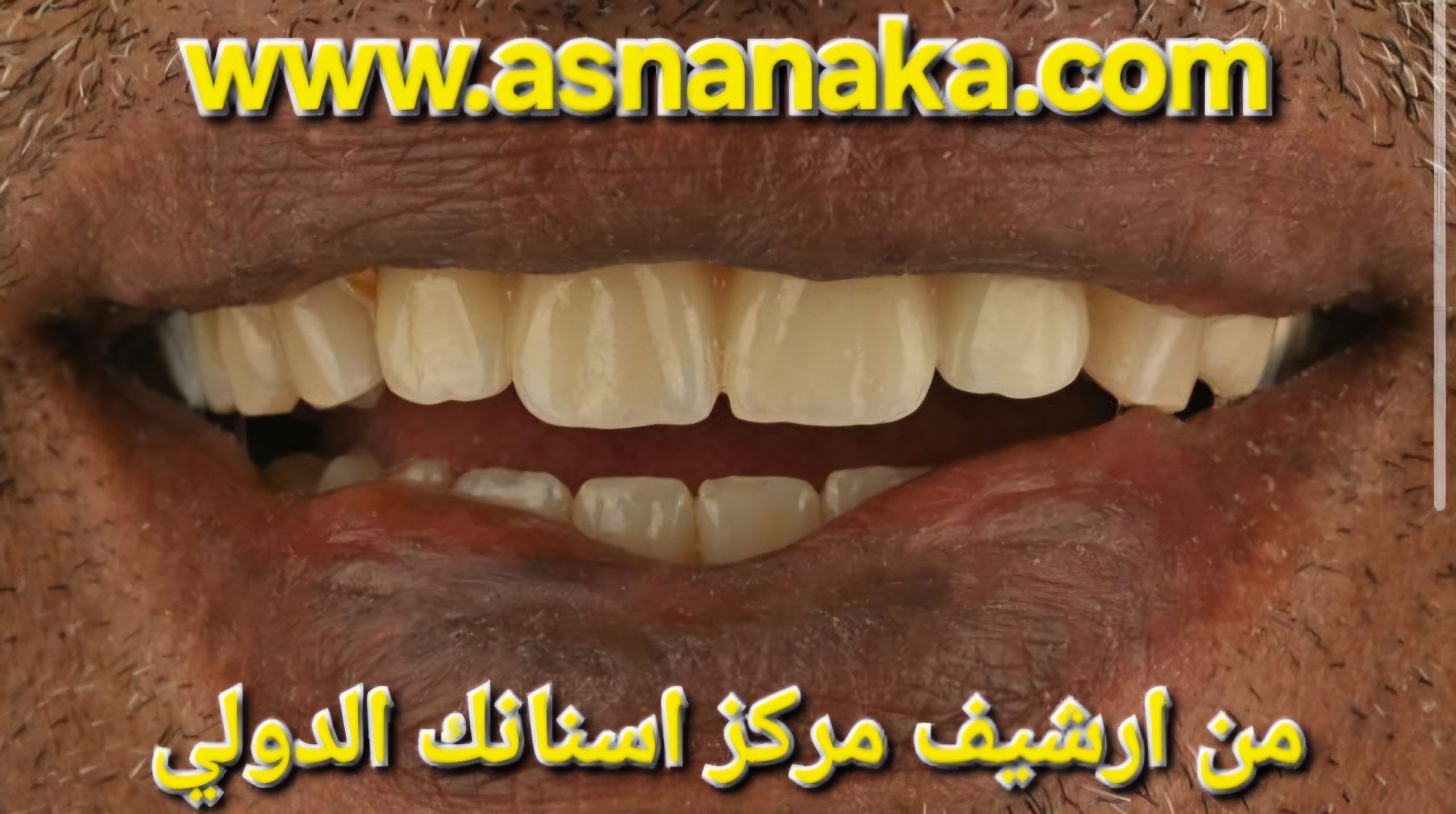 حصول المراجعه على ابتسامه رائعه بعد انتهاء العلاج