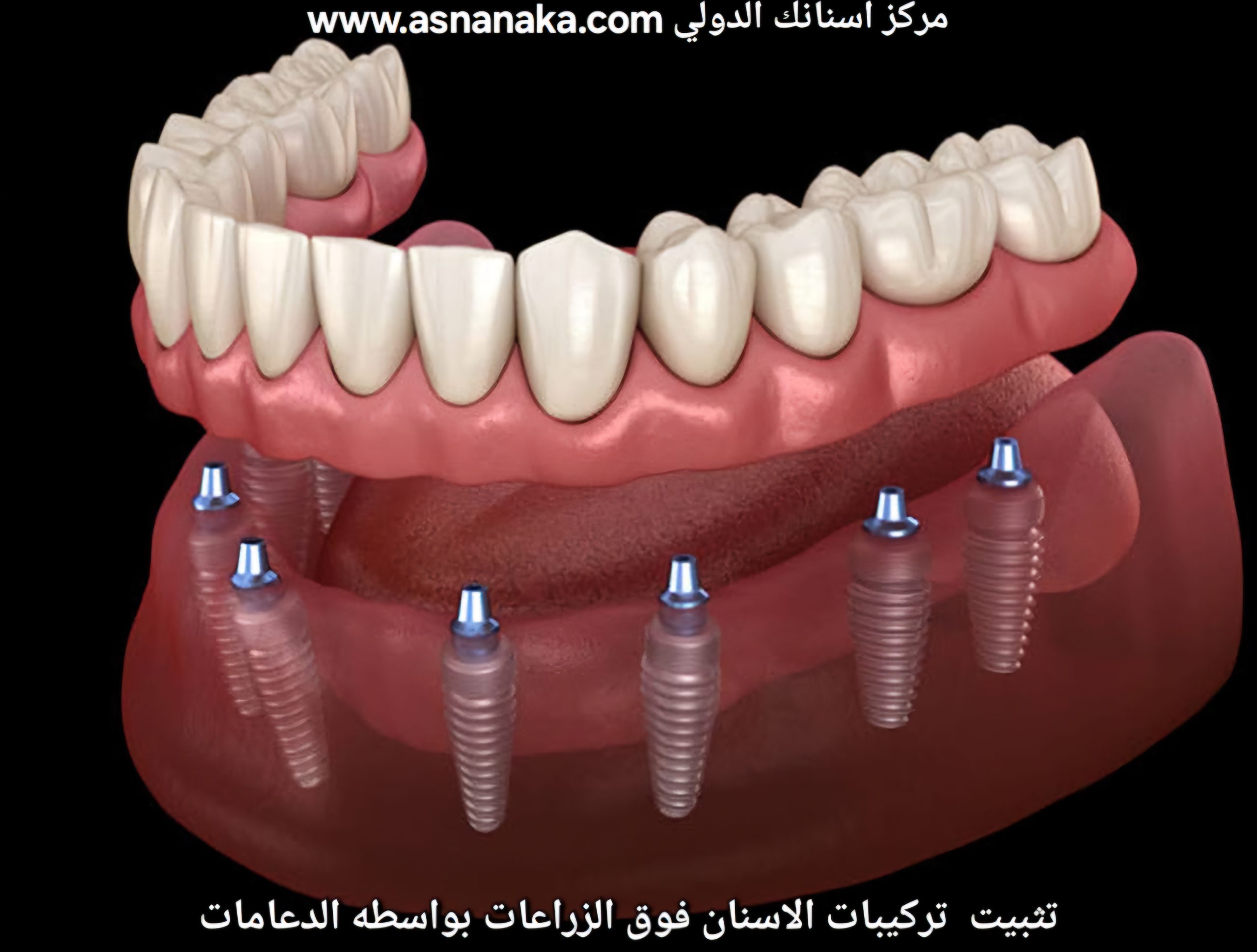 تثبيت التركيبات بواسطة الدعامات