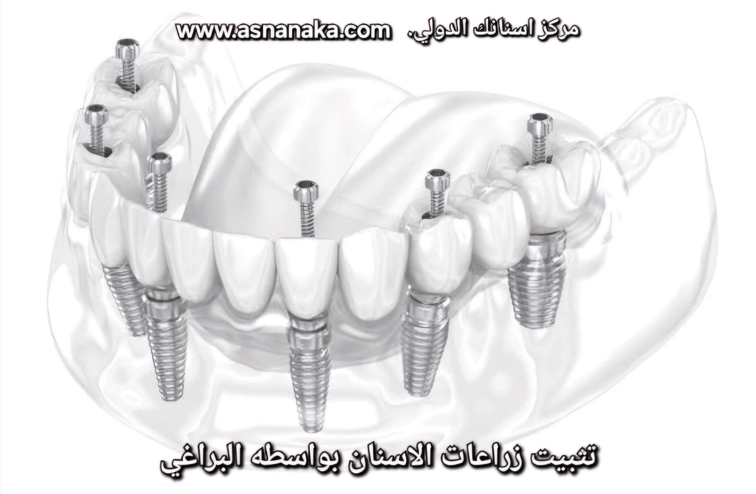 تثبيت زرعات الاسنان بواسطة البراغي