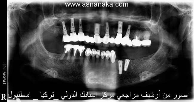 ٩ صوره شعاعيه للمراجعه بعد البدء بالعلاج وزراعه الزراعات الفوريه في الفكين