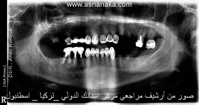 صوره شعاعية للمراجع قبل البدء بالعلاج