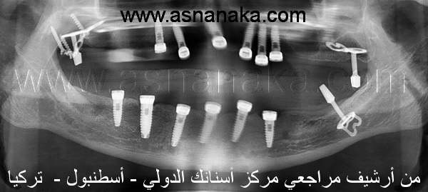 صوره شاعيه لزراعات الاسنان الاثنى عشر من شركه  TBR السويسريه الفرنسيه و ثلاثة زرعات من شركه الدكتور اهد النمساويه في كلا الفكين