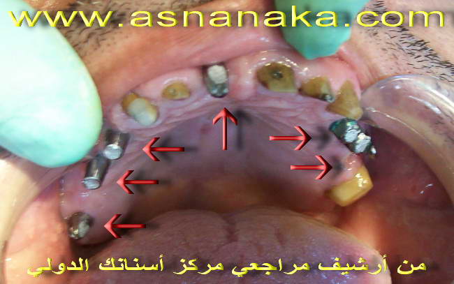 زرعات الاسنان كما تظهر في فك المريض العلوي