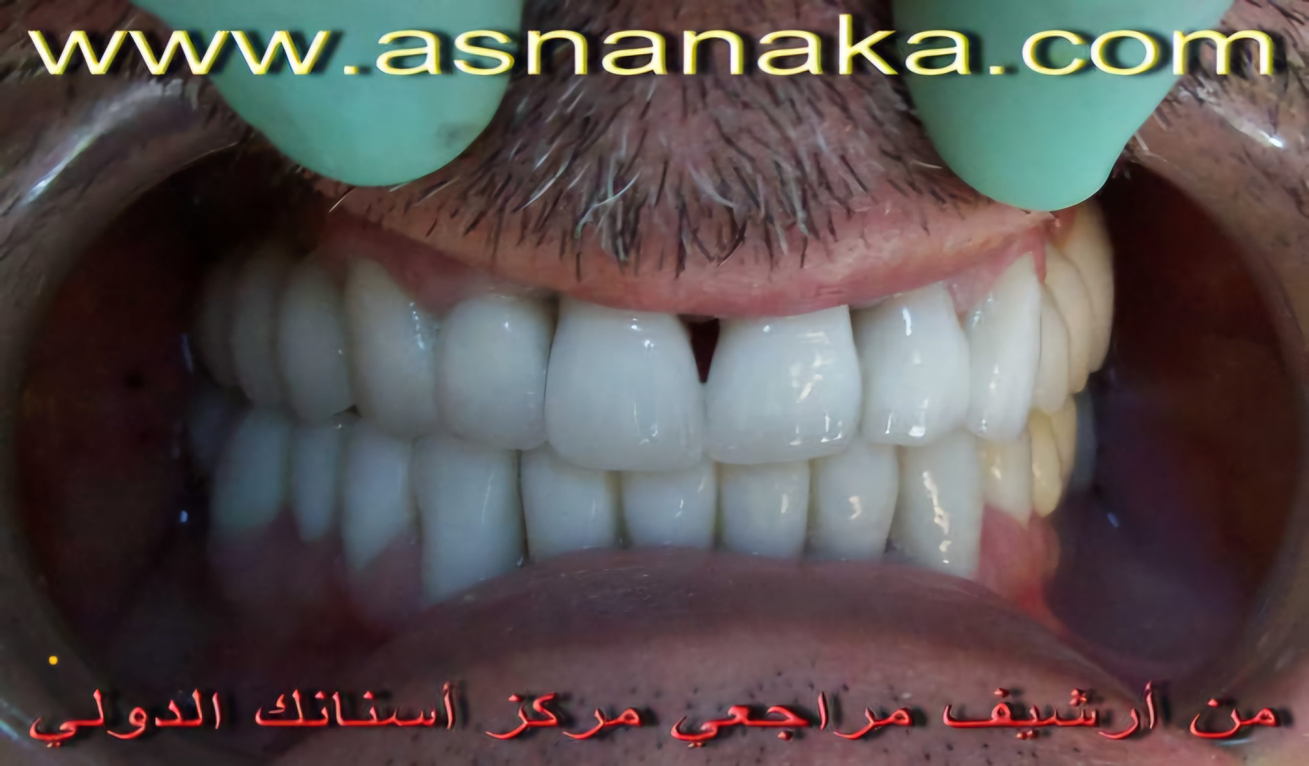 ابتسامه الزميل الطبيب بعد انتهاء العلاج وتركيب الاسنان الزيركونيه فوق الزراعات والحصول على ابتسامه هوليود