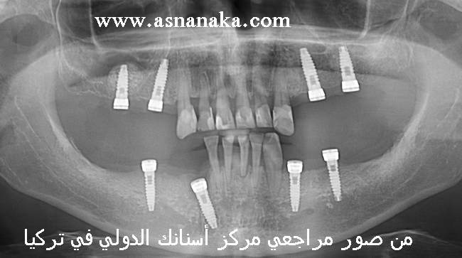 صوره شعاعيه بانوراميه لزرعات الاسنان السويسريه الفرنسيه من شركه TBR