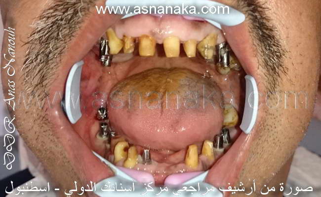 صوره لاسنان مراجعه بعد تحضيرها للدعمات او الابوتمنت التي ركبت فوق الزرعات لاخذ المقاسات وتصنيع التركيبات الاسنان او ابتسامتها