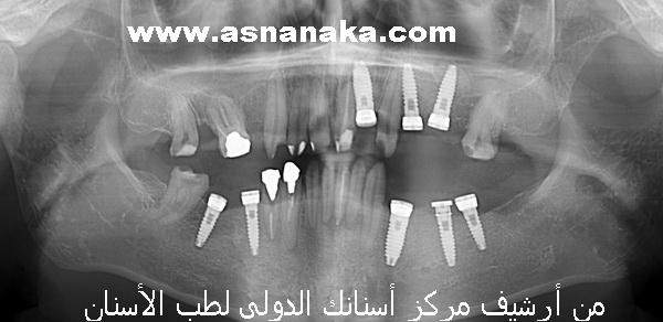 صورة شعاعية بانورامية لزرعات ال tbr