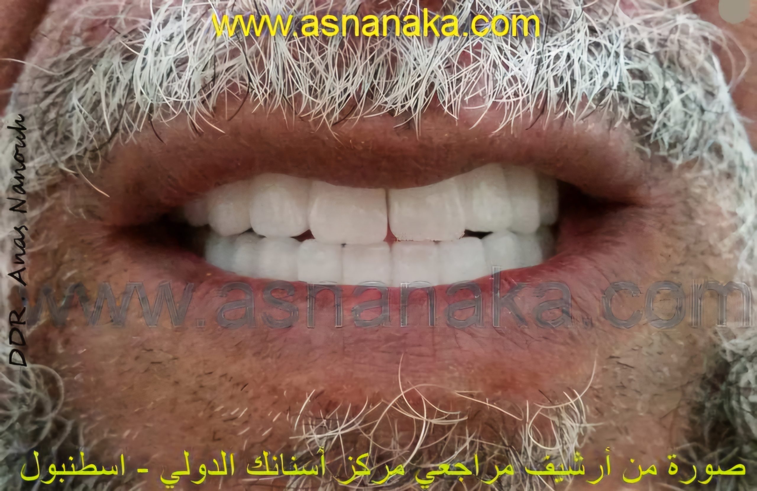 صوره ابتسامه المراجعه بعد تركيب تركيبات الزيركون فوق الزراعات التي مصنوعه من التيتانيوم مع عنق زيركون