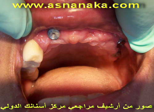 صورة تبين الزرعات في الفم قبل تركيب الأسنان بعد عودتها
