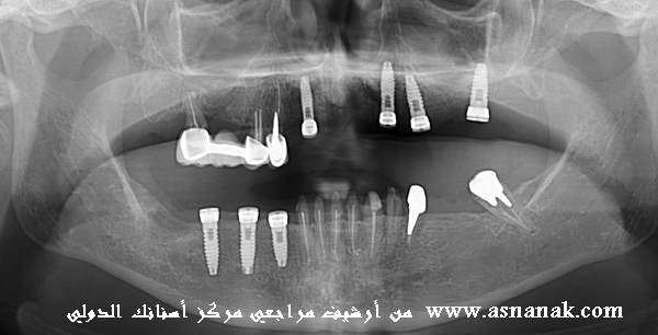 زراعه سبع زراعات لمراجعه من المملكه العربيه السعوديه الزرعات هي من شركه TBR السويسريه الفرنسيه