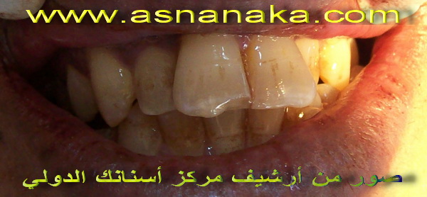 صورة لاسنان المراجع قبل البدا بتركيب الأسنان وزراعة الأسنان