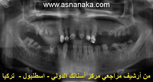 صوره شعاعيه لاسنان المراجع قبل البدء بالعلاج