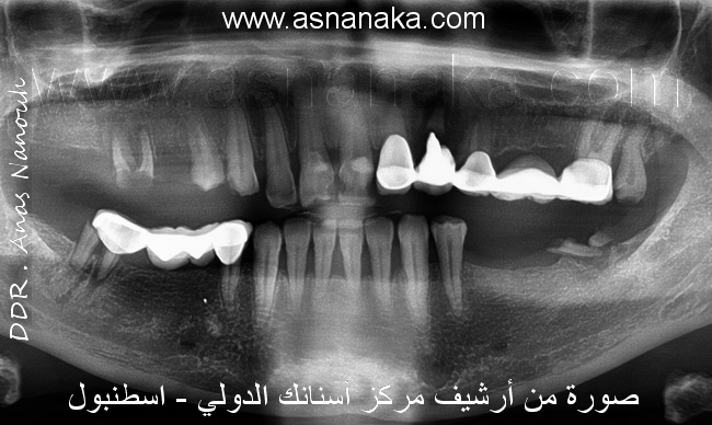 صوره شعاعيه لاسنان المراجعه العراقيه قبل البدء بالعلاج