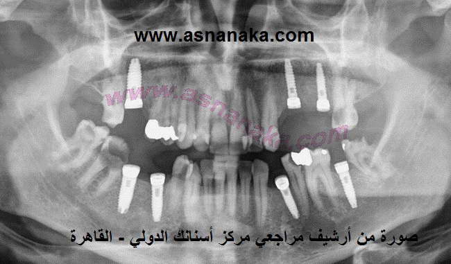 مراجع زرع أسنان عندنا لاحظ الطول الكبير لزرعات بالأضافة للثخانة الكبيرة ، كل هذا يساعد على ضمان عمر أكبر لزرعات و قدرة أكبر على تحمل قوة المضغ