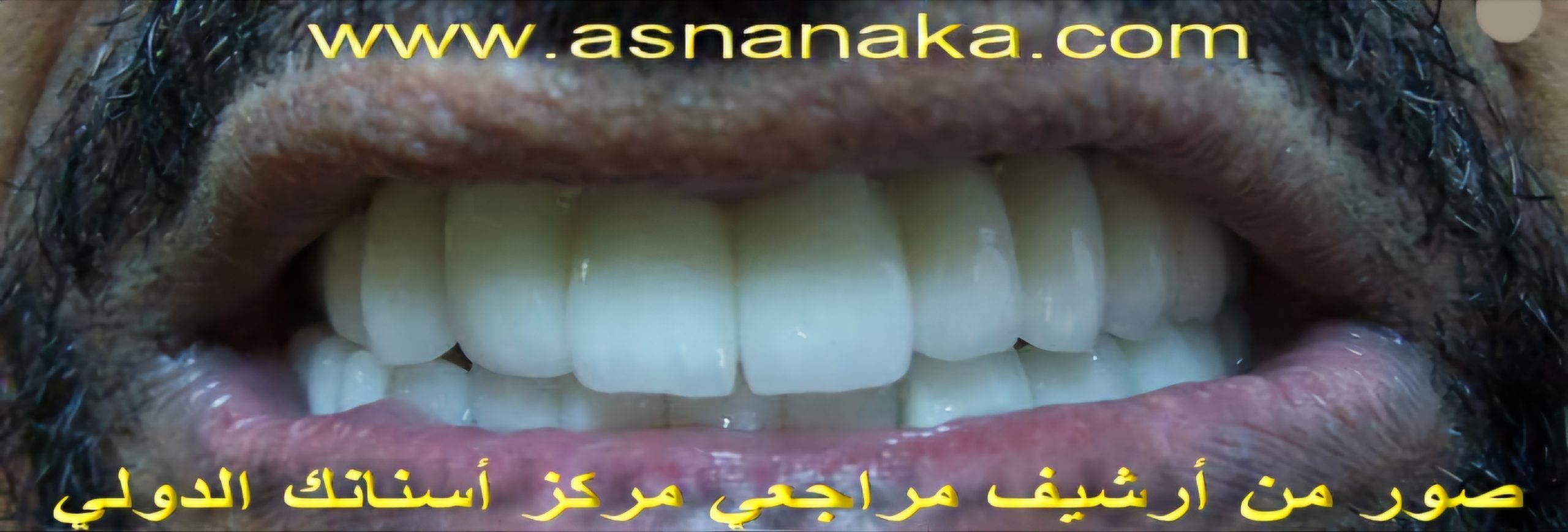 تركيب الابتسامه الزركونيه فوق الاسنان الزرعات من شركه سويسريه الفرنسيه