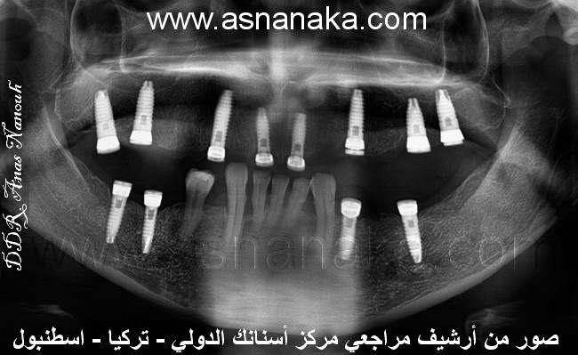 صوره لزراعات الاسنان السويسريه الفرنسيه من شركه والتي لا تسبب التهابات لثه ولا رائحه فم  