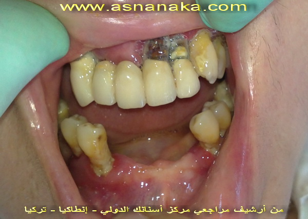 الأخت المغربية قبل البدء في العلاج لاحظ الدمار الكامل في كل الأسنان واللتهابات المعممة في اللثة