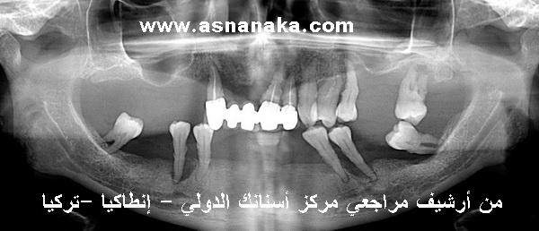 الأخت المغربية قبل البدء في العلاج لاحظ الدمار الكامل في كل الأسنان واللتهابات المعممة في اللثة