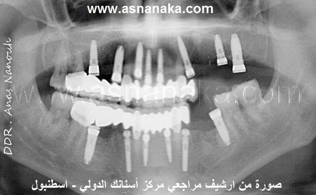 صوره شعاعية بانورامية ويظهر فيها زرعات الاسنان