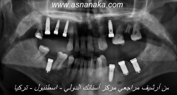 صوره شعاعيه لزراعات الاسنان القزرعت في فم المراجع زراعه سويسريه فرنسيه من شركه