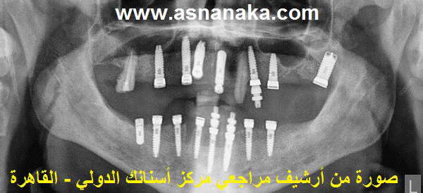 صوره شعاعيه لزراعات الاسنان القديمه والحديثه