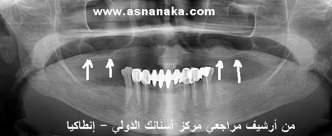 الصورة الشعاعية هنا توضح حالة الجيوب الأنفية التي لا يفصل بينها وبين سقف الحنك سوى غشاء رقيق بدون وجود أي عظم