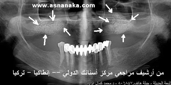 هذه الصورة توضح بالأسهم مكان وضع العظم الصناعي والطبيعي في الجيوب الأنفية وعملية رفع الجيوب من أجل زراعة الأسنان