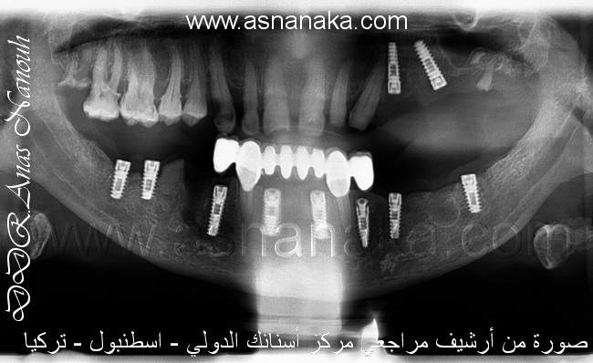 صوره شعاعيه للزراعات الثمانيه في الفك السفلي والزرعتين في الفكه العلوي من شركة ريتر اللمانية