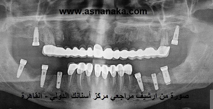 الصورة تظهر :
1- الجسر الذي تم وضعه فوق الأسنان الثلاثة ومن تحته يظهر المنطقة التي تم قلع الأسنان منها والتي تم زراعة العظم فيها
2- كما يظهر في الصورة الزرعات الثمانية التي تم زراعتها في الفكين