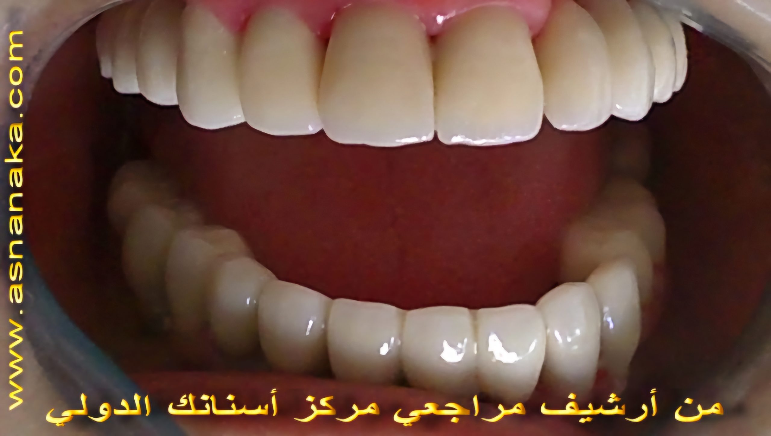 تركيب ابتسامه هوليود فوق الزرعات والاسنان المحضره والمصنوعه من الزيركون