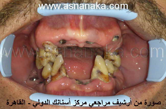 صورة لفم المراجع قبل البدء بتركيب التركيبات على زرعات الأسنان ، و الأسنان المتبقية تم علاجها