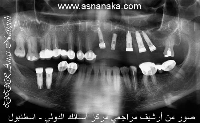 زراعه زرعتين في الفك السفلي وخمس زرعات في الفك العلوي لمراجع من السودان