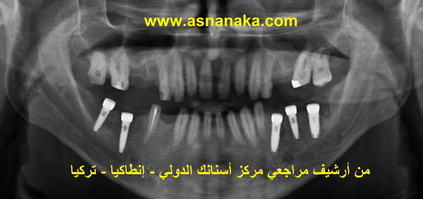 صوره شعاعيه بانورامية للفكين لاحظ وجود خمس زرعات في الفك السفلي مع وجود فتحه بين الاسنان الاماميه حيث ان المراجع لم يكن يستطيع تسكير الأسنان الامامية للفكين السفلي مع العلوي