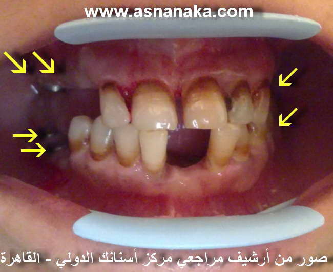 صوره لاسنان المراجعه ولزراعات الاسنان قبل البدء في وضع الدعامات فوق الزراعات وتحضير الاسنان