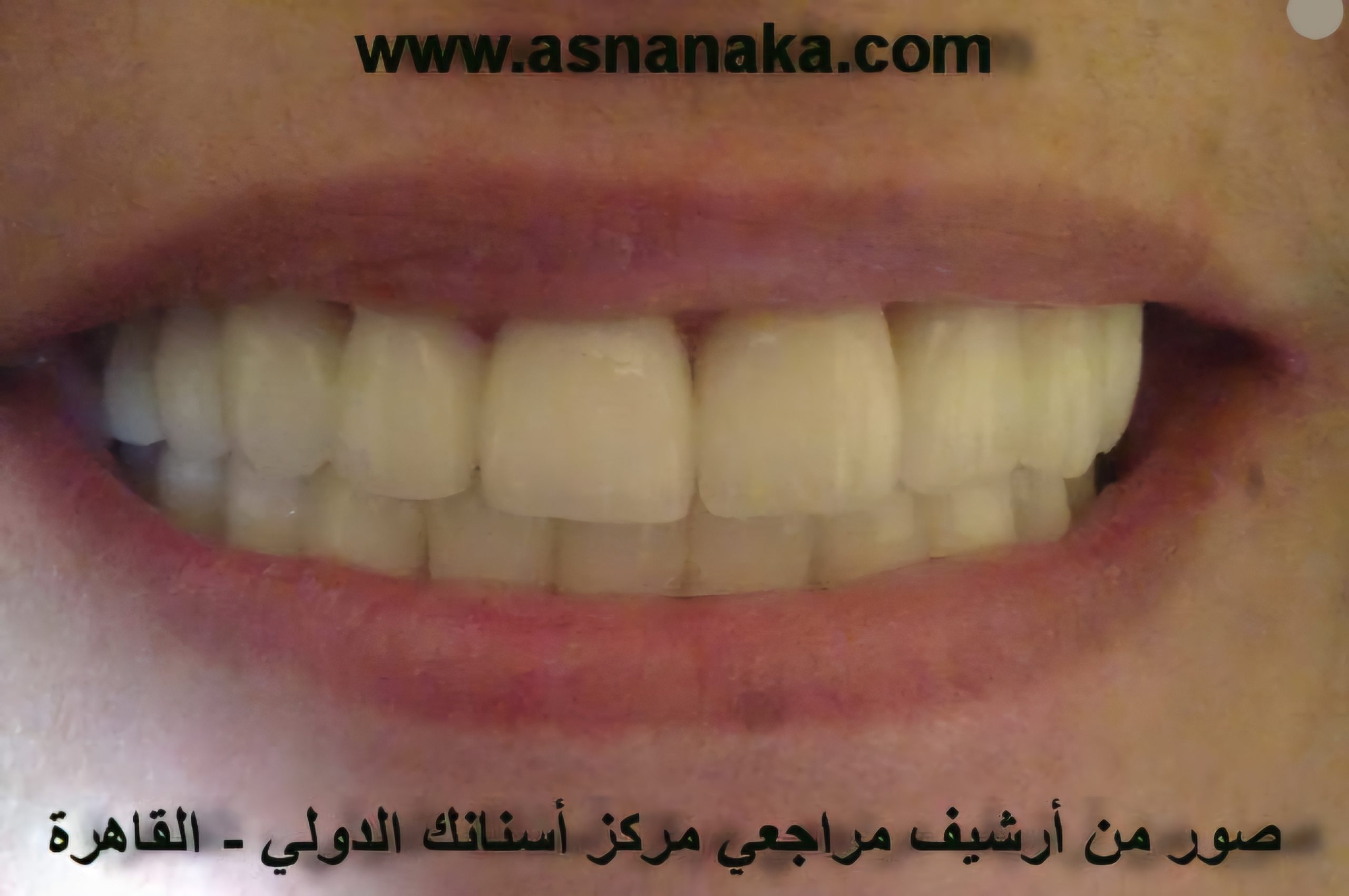 ابتسامه المراجعه الرائعه بعد تركيب الاسنان فوق الزرعات وفوقها الاسنان الطبيعيه والحصول على ابتسامه رائعه من الزركون