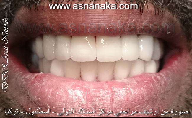 تركيب ابتسامه هوليود مصنعه من الزرقاء مع وجه تجميل من الايماكس فوق الزرعات وفوق الاسنان الباقيه