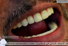 أبتسامة المراجع بعد تركيب أسنان الزريكون فوق الزرعات والحصول على أسنان صحية يمكن أن يمضغ عليها الطعام مدى الحياة إذا أرد الله