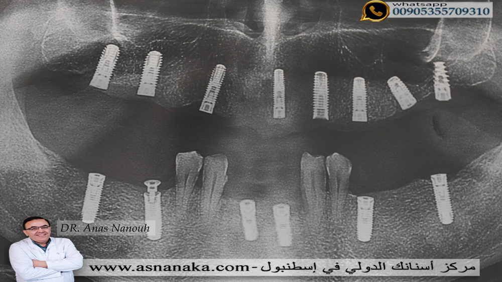 زراعة الأسنان الألمانية في كلا الفكين مع الحفاظ على بعض الأسنان الطبيعية