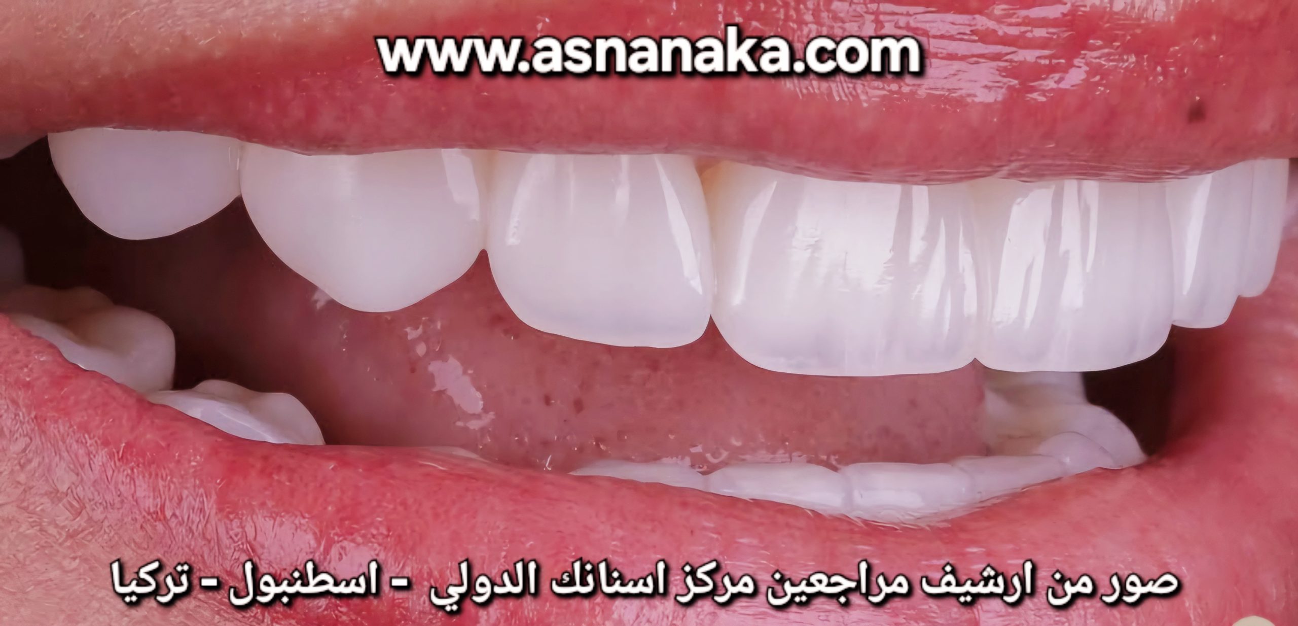 صوره لابتسامه المراجع الرائعه بعد تركيب تركيبات الزركون مع وجه تجميل من الايماكس فوق الزرعات