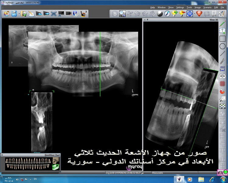 جهاز اشعه البانوراما المقطعيه في مركز اسنانك الدولي في اللاذقيه